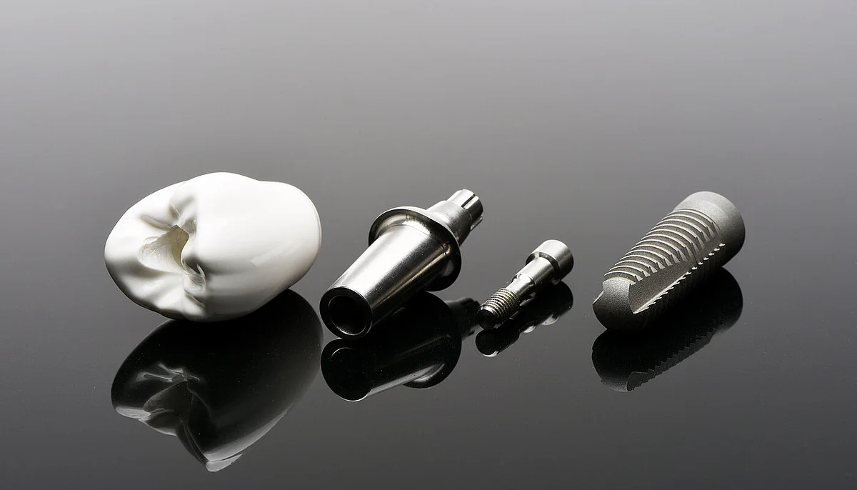 Zahnimplantat-Komponenten auf schwarzer Oberfläche: Keramikkrone, Abutment, Schraube und Implantatkörper.